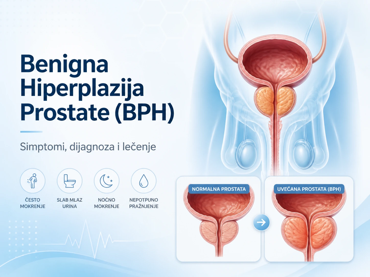 Medicinska ilustracija benigne hiperplazije prostate sa prikazom normalne i uvećane prostate