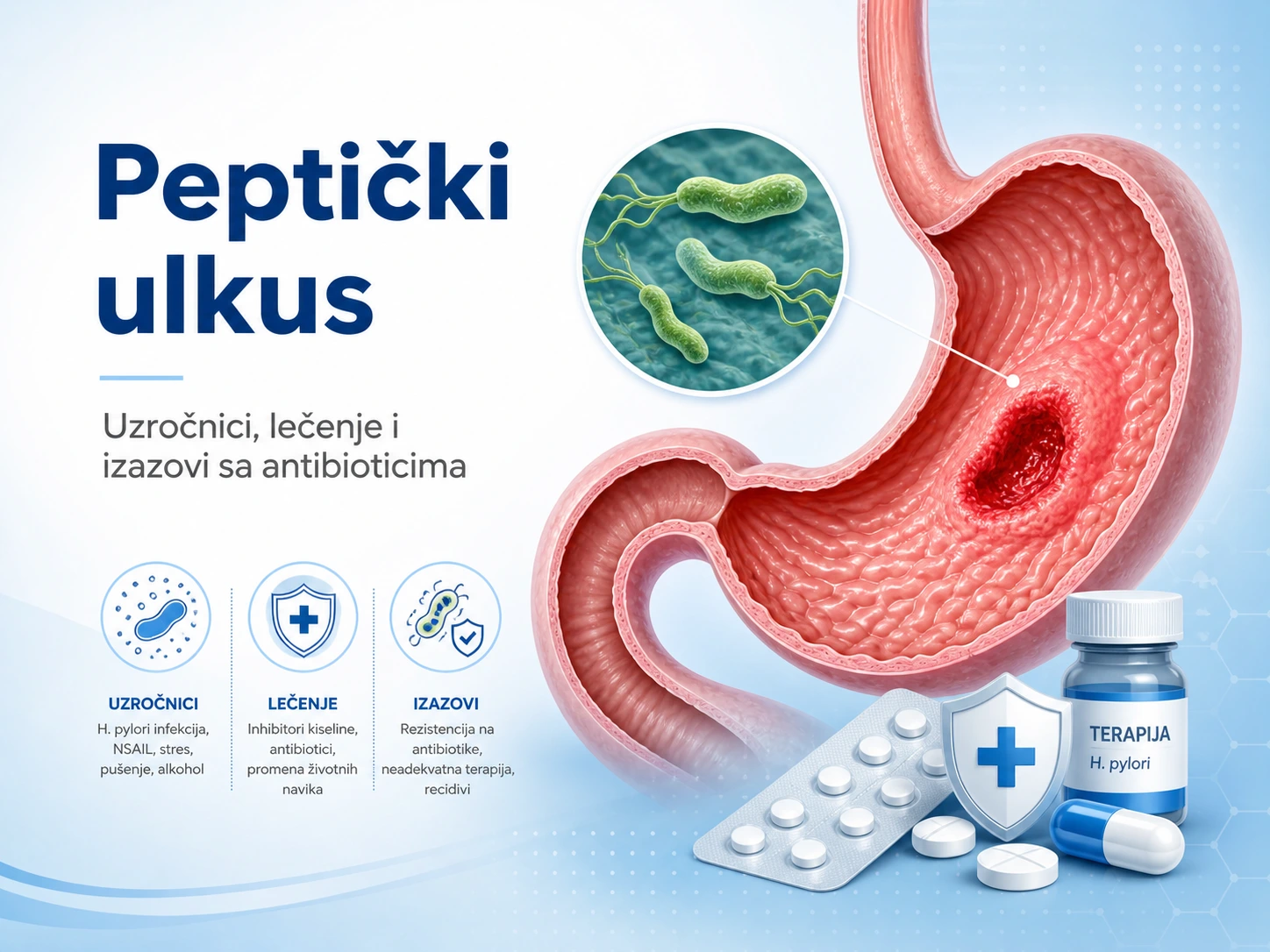 Medicinska ilustracija peptičkog ulkusa sa prikazom želuca, Helicobacter pylori bakterije i terapije antibioticima