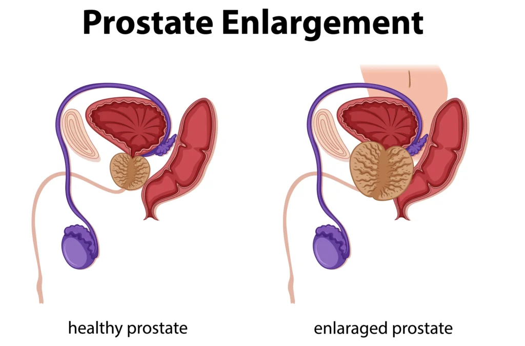 benigna hiperplazija prostate (BPH)